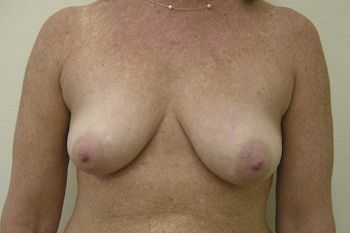 Breast Lift Before & After Patient 04
