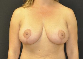 Breast Lift Before & After Patient 06
