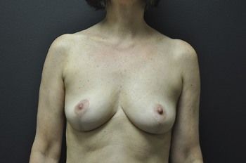 Breast Lift Before & After Patient 07