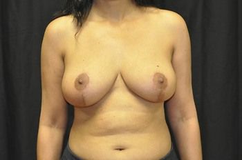 Breast Lift Before & After Photo Patient 12 Thumbnail
