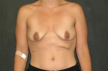 Breast Lift Before & After Patient 13