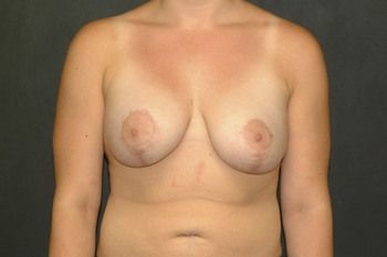 Breast Lift Before & After Patient 15