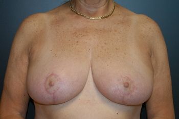 Breast Lift Before & After Patient 19