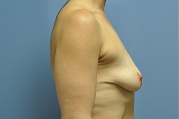 Breast Lift Before & After Patient 28