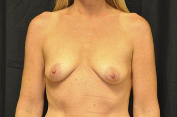 Breast Reconstruction Before & After Photo Patient 05 Thumbnail