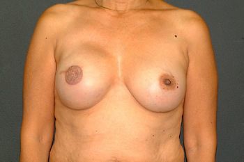 Breast Reconstruction Before & After Patient 12