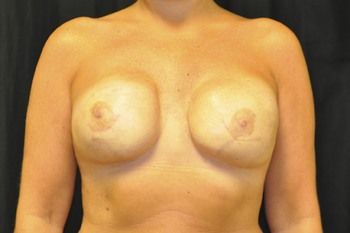 Breast Reconstruction Before & After Photo Patient 14 Thumbnail