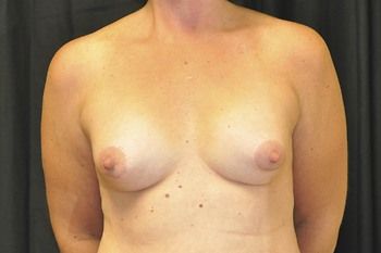 Breast Reconstruction Before & After Patient 15