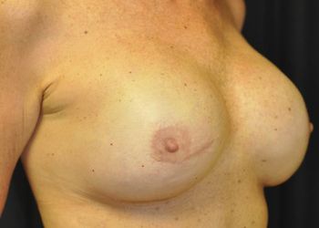Breast Reconstruction Before & After Patient 16