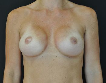 Breast Reconstruction Before & After Photo Patient 17 Thumbnail