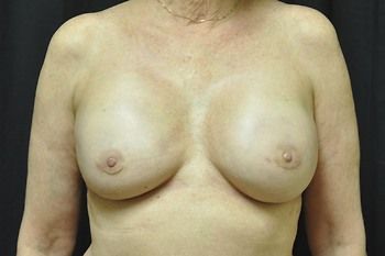 Breast Reconstruction Before & After Patient 20