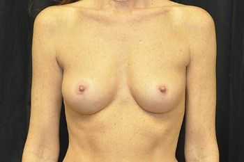 Breast Reconstruction Before & After Photo Patient 21 Thumbnail