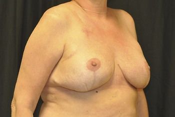 Breast Reconstruction Before & After Photo Patient 22 Thumbnail