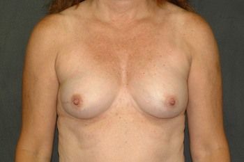 Breast Reconstruction Before & After Photo Patient 25 Thumbnail