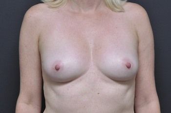 Breast Reconstruction Before & After Photo Patient 26 Thumbnail