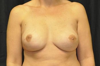 Breast Reconstruction Before & After Patient 30