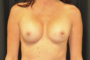 Breast Reconstruction Before & After Patient 31