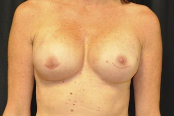 Breast Reconstruction Before & After Photo Patient 31 Thumbnail