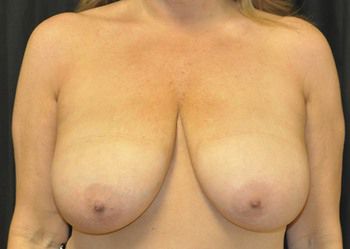 Breast Reduction Before & After Photo Patient 06 Thumbnail