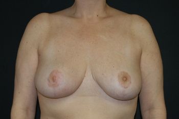 Breast Reduction Before & After Patient 08