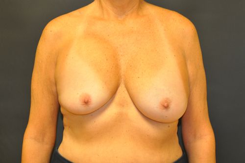 Breast Revision Before & After Photo Patient 01 Thumbnail