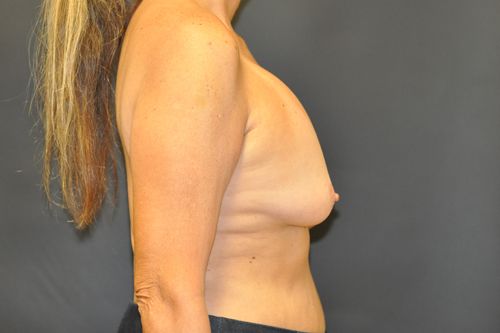 Breast Revision Before & After Patient 01