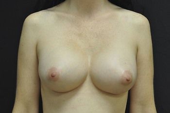 Breast Revision Before & After Photo Patient 02 Thumbnail