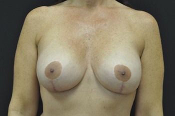Breast Revision Before & After Patient 05