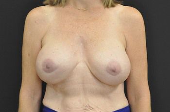 Breast Revision Before & After Patient 06