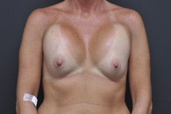Breast Revision Before & After Patient 09