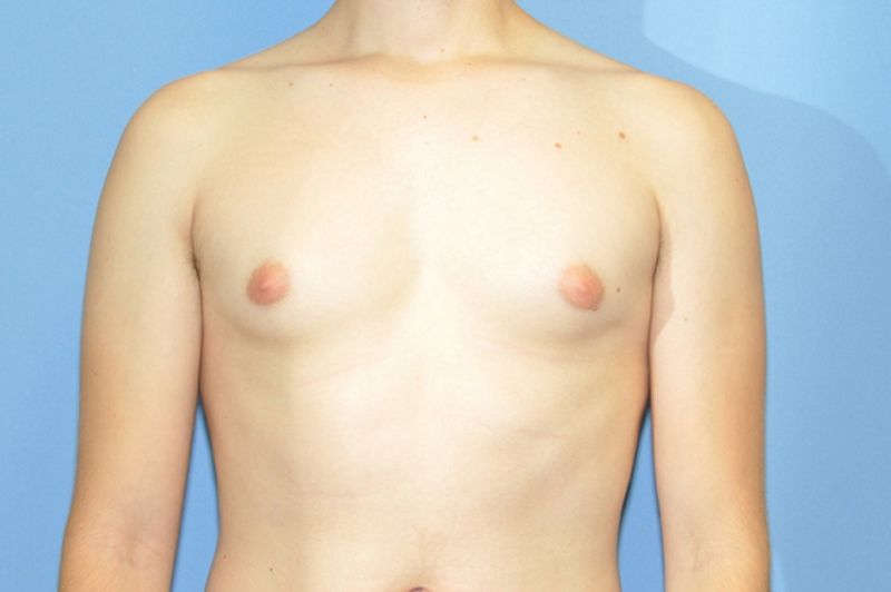 Male Breast Reduction Before & After Patient 01