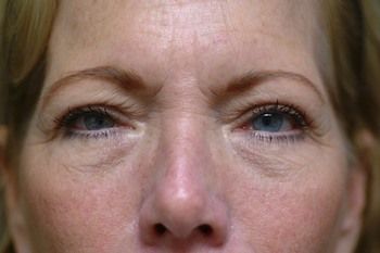 Eyelid Blepharoplasty Before & After Patient 01