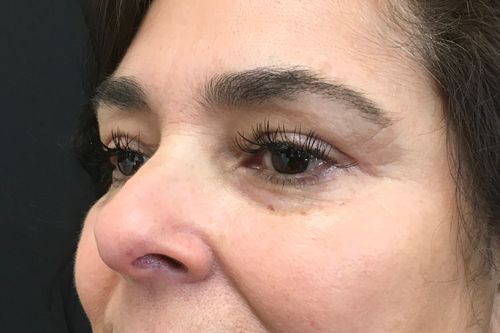 Eyelid Blepharoplasty Before & After Patient 07