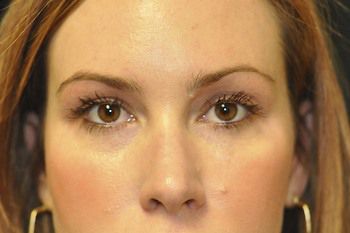 Eyelid Blepharoplasty Before & After Patient 08