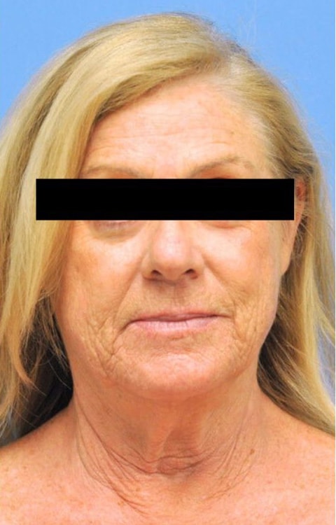 Facelift Before & After Photo Patient 08 Thumbnail