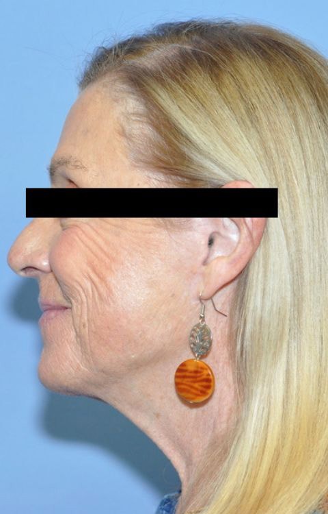 Facelift Before & After Photo Patient 08 Thumbnail
