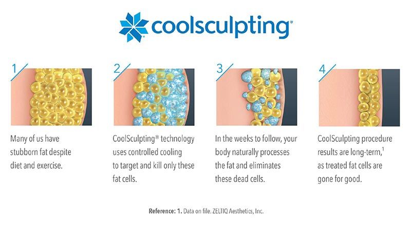 CoolSculpting