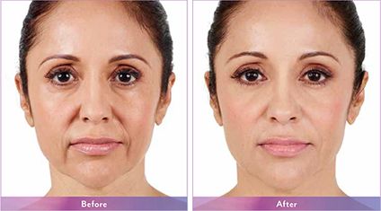 Injectable Fillers before and after