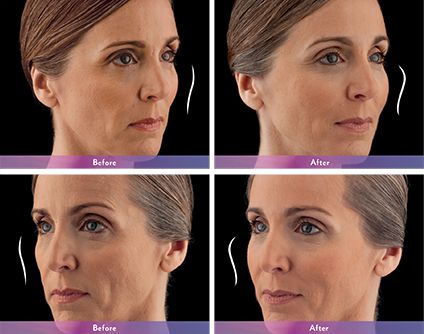 Dermal Fillers before and after