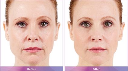 Injectable Fillers before and after