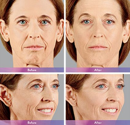 Dermal Fillers before and after