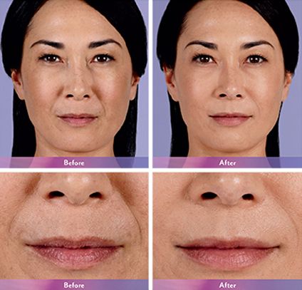 Injectable Fillers before and after