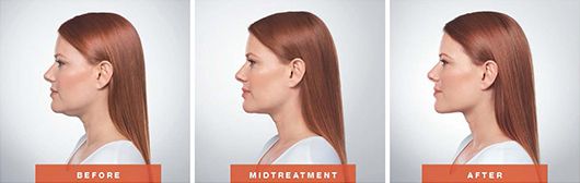 Kybella Before & after