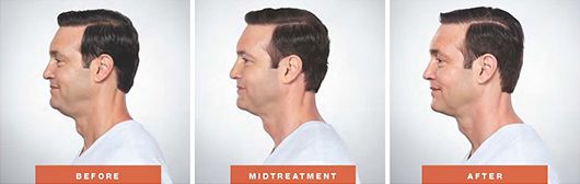 Kybella Before & after