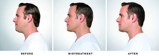 Kybella Before & after