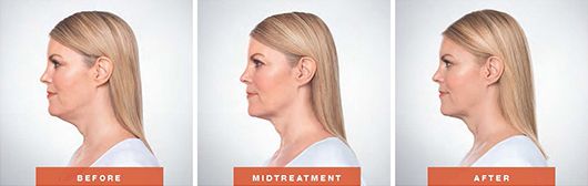 Kybella Before & after