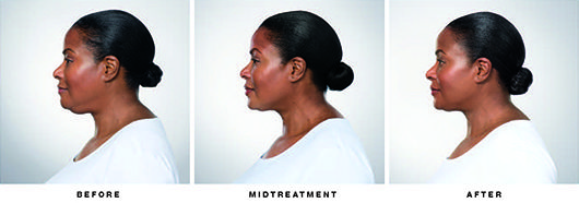 Kybella Before & after