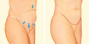 Tummy Tuck Diagram