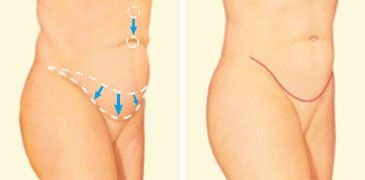 Tummy Tuck Diagram