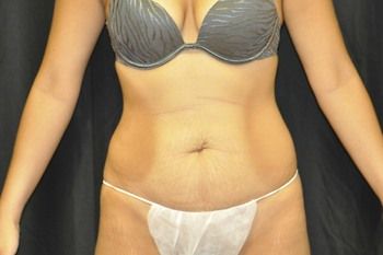 Abdominoplasty Before & After Patient 02